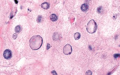 1073277_non-alcoholic-fatty-liver-micrograph-ss-17 1073277_non-alcoholic-fatty-liver-micrograph-ss-17