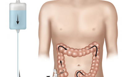 Constipation in CMC Constipation in CMC