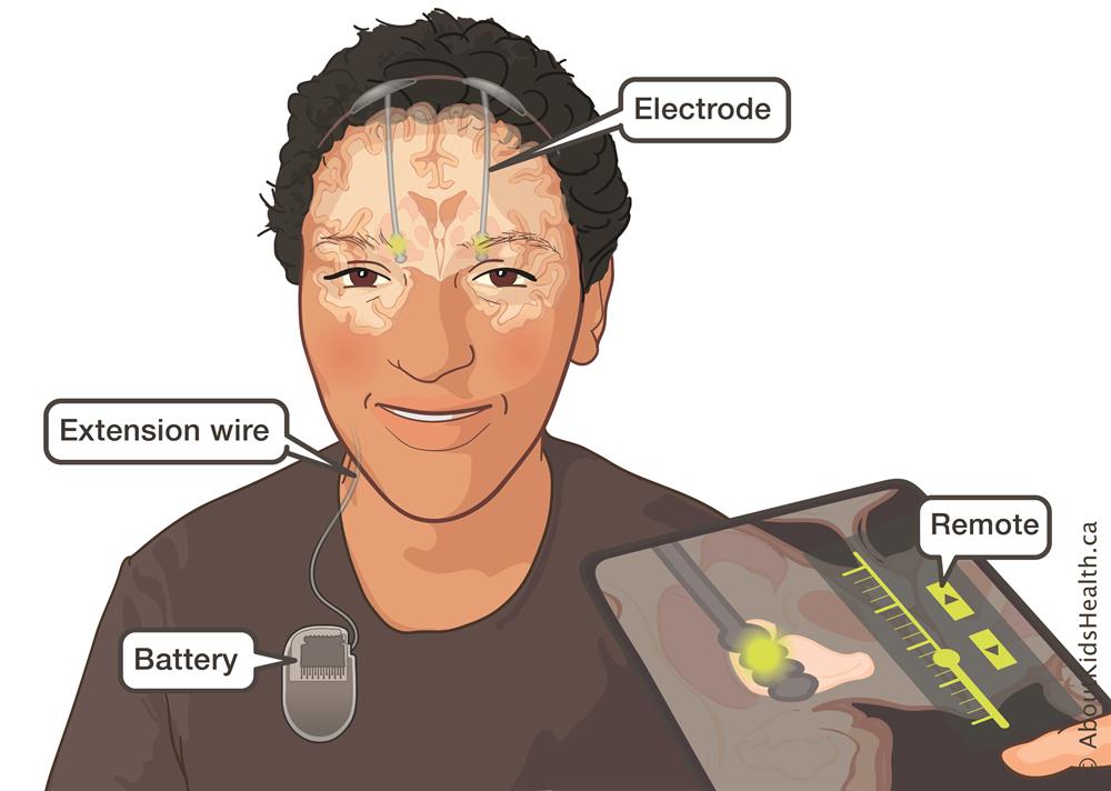 Paediatric Deep Brain Stimulation illustration by About Kids Health