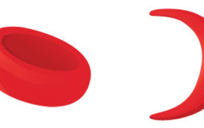 Sickle Cell Sickle Cell
