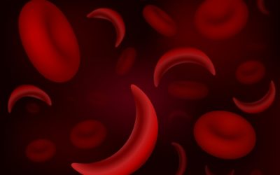 sickle_cell_overview27471673_L